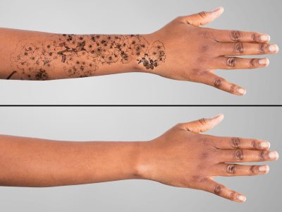 Laser Tattoo Removal On Woman's Hand Against Grey Background