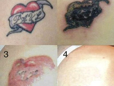 removing-tattoo-with-dermabrasion-1